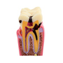 HST 六倍龋齿双侧对比模型 M2 成人病理模型 病理模型 病历模型 模型 病理膜型 龋齿模型 对比模型 龋齿双侧对比模型
