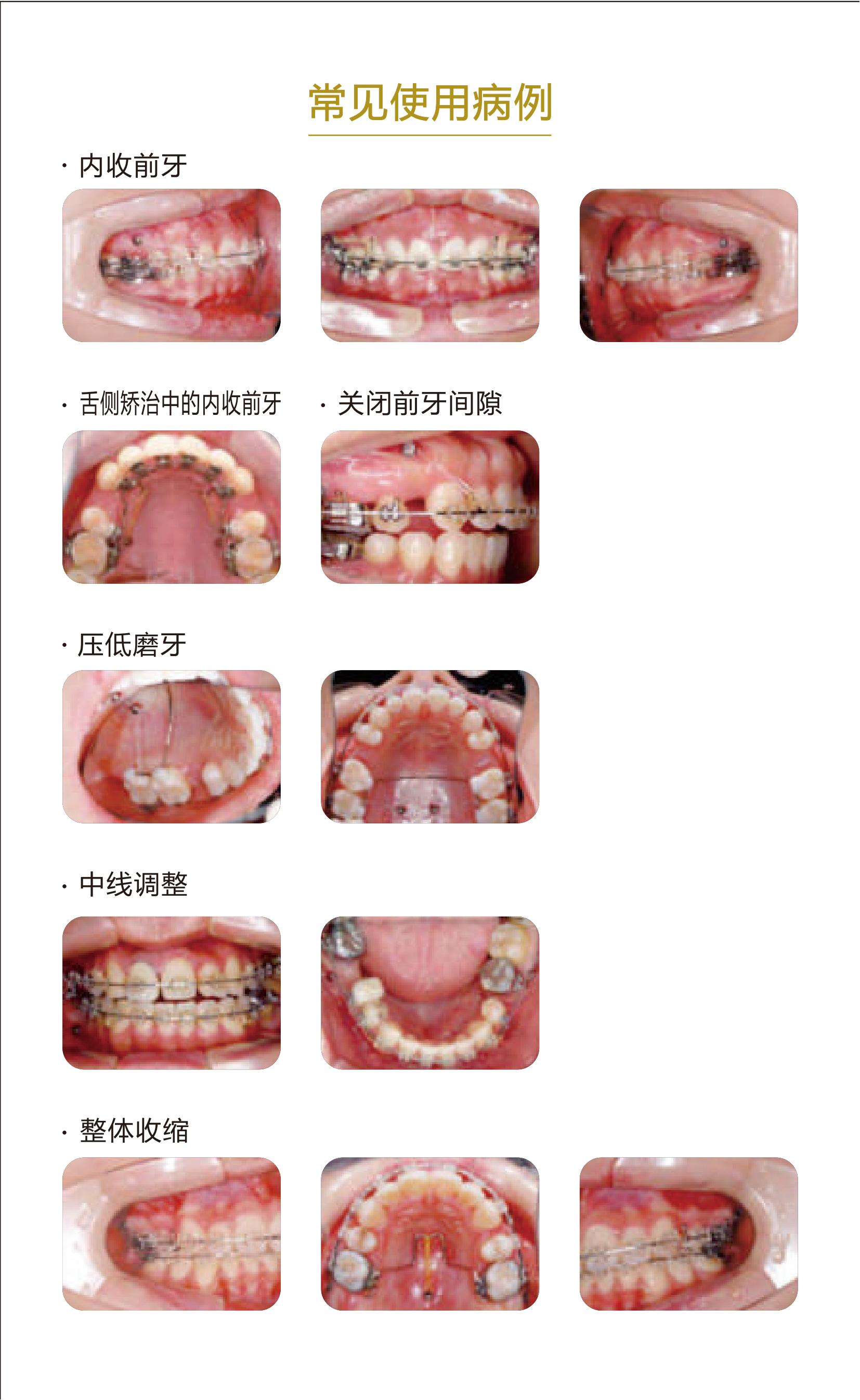 56182210925808295 欣如三折页-BMK支抗钉2022-4.jpg