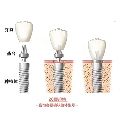 奥齿泰/OSSTEM MS种植体+牙冠+个性基台 1套（20颗起售，咨询客服确认植体型号）